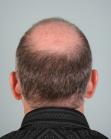 Before Hair Transplant&nbsp;2 Sessions (Areas)